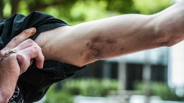 Daniel Meyers' scarred arm. Photo: Karleen Minney
