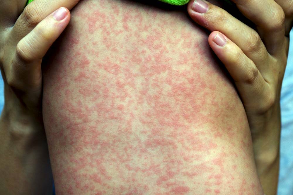 Measles alert: Warning issued after 22-year-old man diagnosed in Dubbo