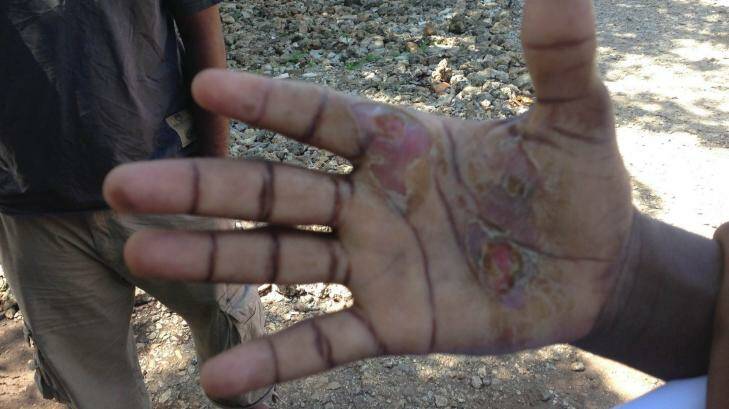 The hand of an asylum seeker who claims navy personnel deliberately held it to a hot exhaust fan.  Photo: Amilia Rosa