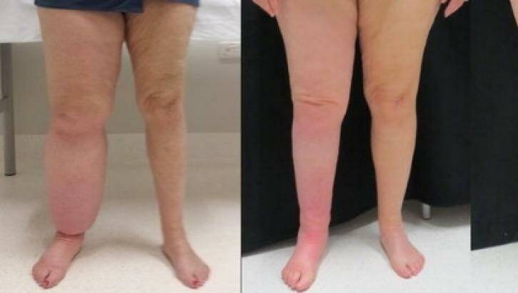 A patient whose right leg is affected by lymphoedema (left) before liposuction and six months after treatment. Photo: Macquarie University Hospital Lymphoedema Program